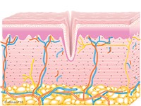 Graphic of Untreated Skin